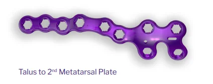 Purple talus-to-second-metatarsal plate used as the source geometry