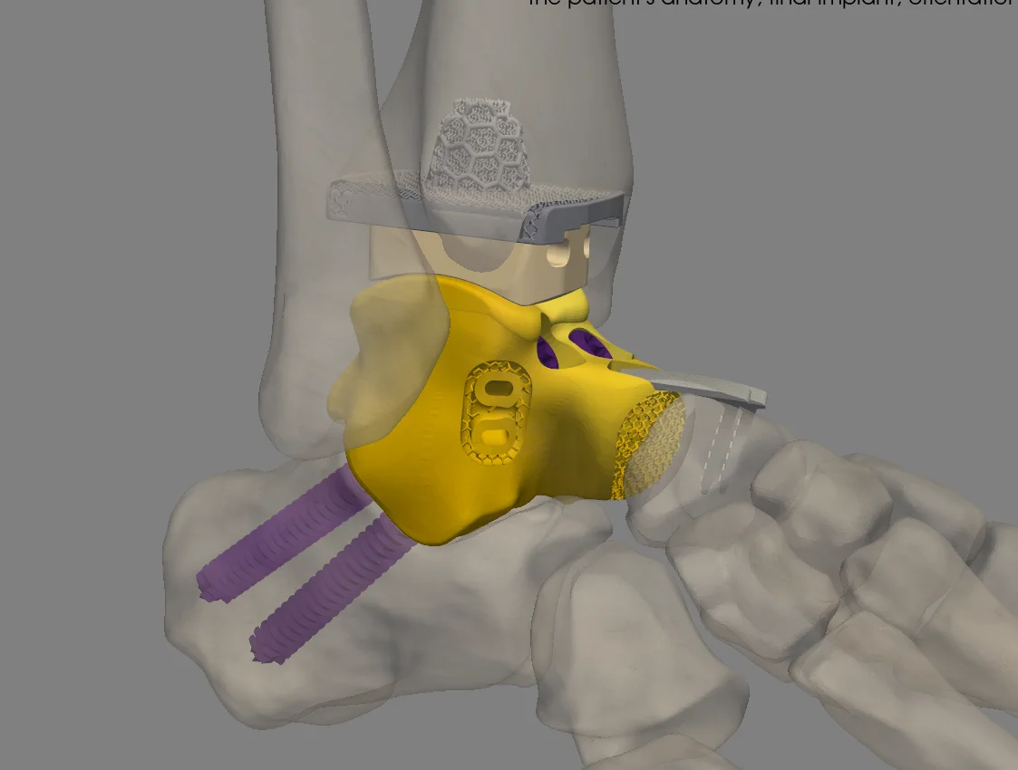 Configured ankle implant model in the visualization application