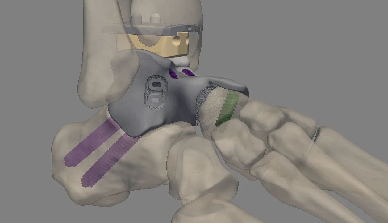 Three-dimensional ankle anatomy with configured implant components